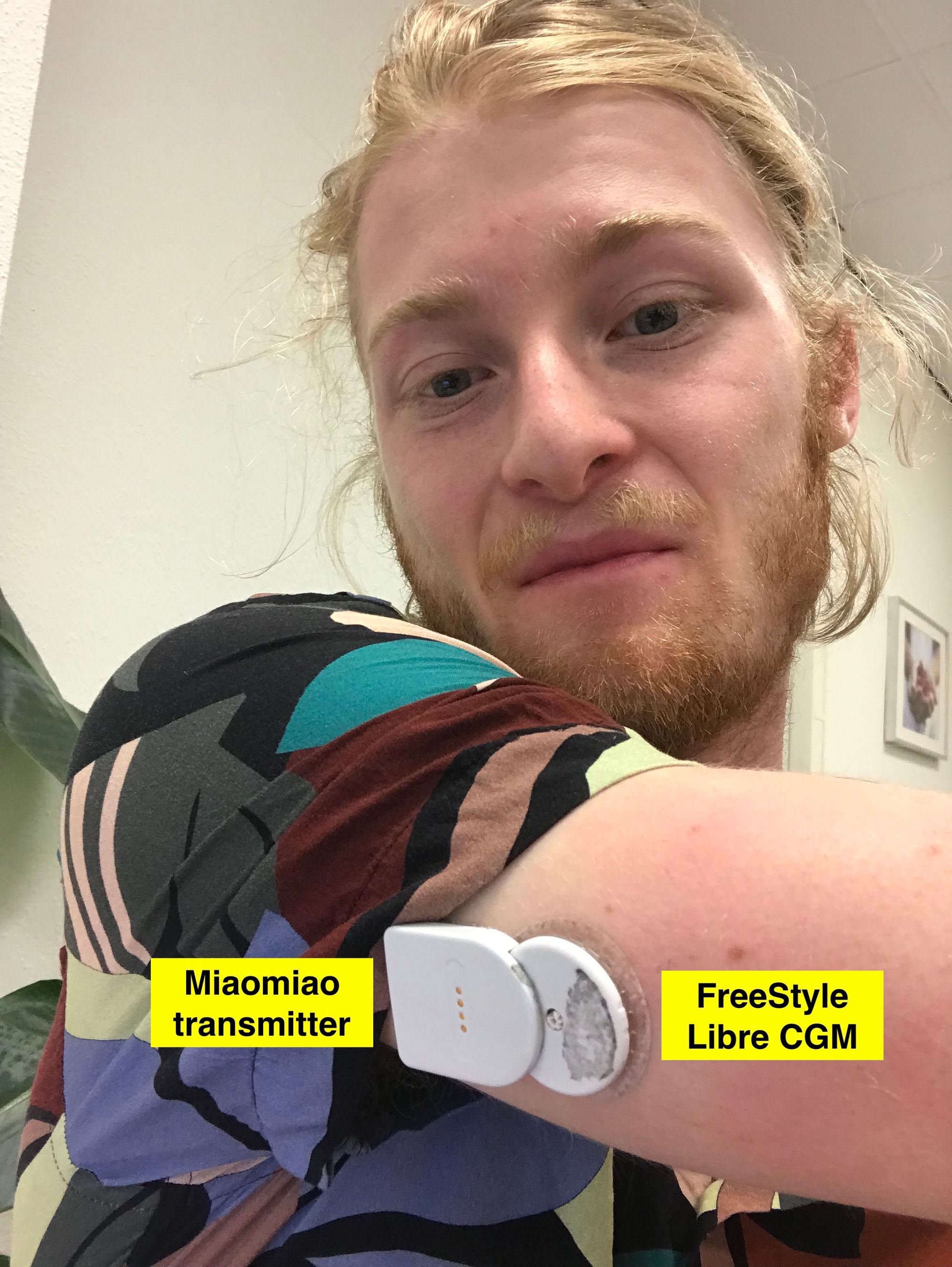 I'm a cyborg now! (On Building My Own Artificial Pancreas)