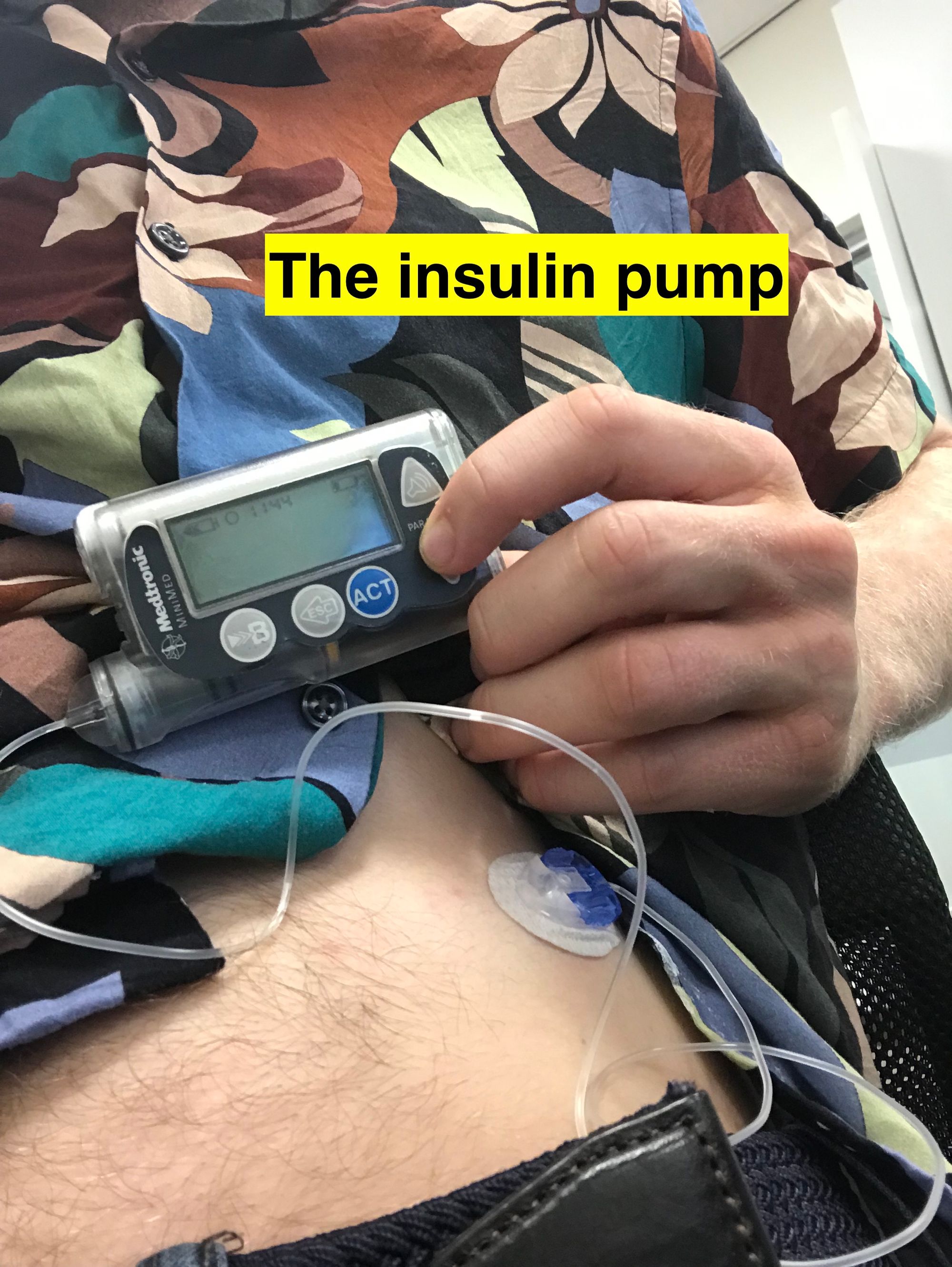 I'm a cyborg now! (On Building My Own Artificial Pancreas)